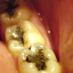 Amalgam
